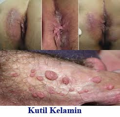 Illustration for article titled Obat Menghilangkan Kutil Di Bibir Vagina
